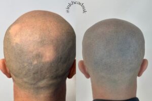 Alopecia