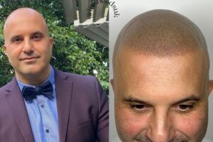 Baldness