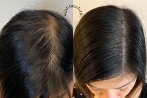 Female Pattern Baldness