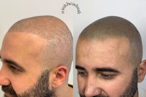 Hair Transplant Coverup