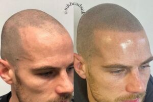 hairloss