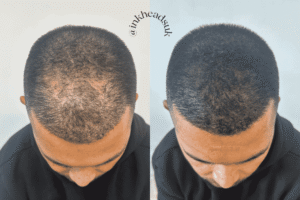 Thinning hair